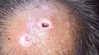 Según informes, se hallaron larvas en cabeza, oído, cuello y piernas