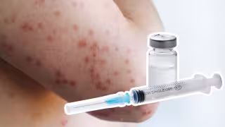 Se han confirmado 14 casos de sarampión en Campeche desde 2025 y no hay nuevos contagios en 2026.