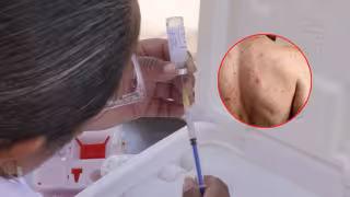 Campeche suma 9 casos confirmados de sarampión en 2026.