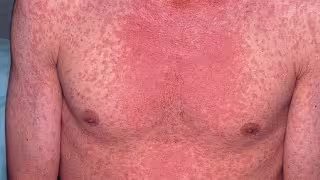 El sarampión puede causar la muerte por complicaciones graves, no solo por la erupción o la fiebre.