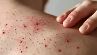 El sarampión es una enfermedad viral altamente contagiosa, prevenible mediante esquemas completos de vacunación