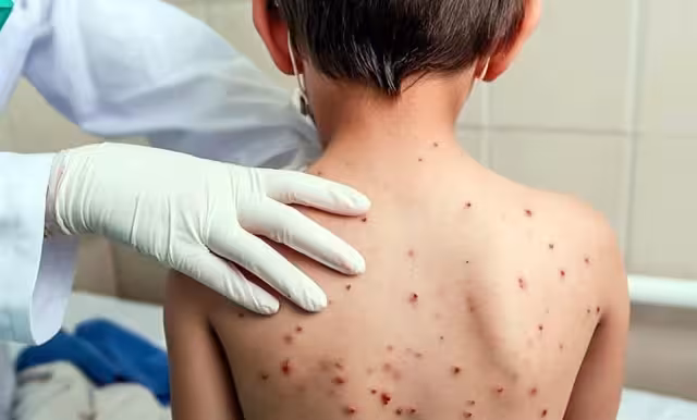 Campeche rompe récord de inmunidad: tres contagios de sarampión