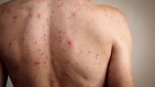 ISSSTE llama a derechohabientes a evitar automedicación ante síntomas sospechosos