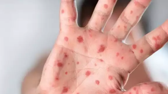 Un caso activo de viruela símica en Quintana Roo