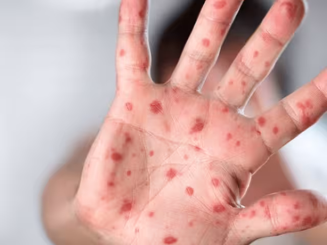 Un caso activo de viruela símica en Quintana Roo