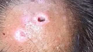 Confirman séptimo caso de miasis humana en México