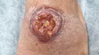 Incremento de 1175% en leishmaniasis cutánea