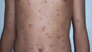 Varicela contagia a 229 menores; 48 casos más que el año pasado