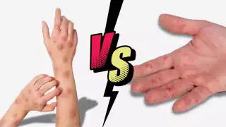 Viruela Símica vs Varicela: ¿Cuáles son las diferencias y los síntomas?