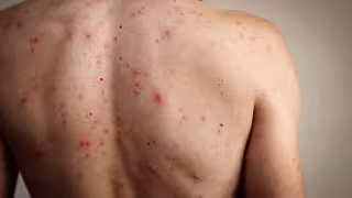 Confirman quinto caso de sarampión en Campeche en menos de un mes.