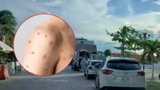 Se reportó cerca de la medianoche que no se trataba de un caso de viruela símica