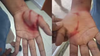 El menor fue llevado al hospital para ser atendido debido a sus heridas en manos y torso
