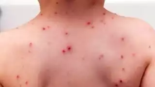 Campeche registra más de 250 contagios de varicela en lo que va del año