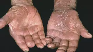 Campeche confirma su primer caso de lepra en 2025, registrado durante la semana epidemiológica 15