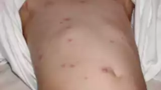 Quintana Roo registra incremento de casos sospechosos de sarampión; exhortan a vacunarse