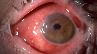 ¿Cómo distinguir la conjuntivitis viral?