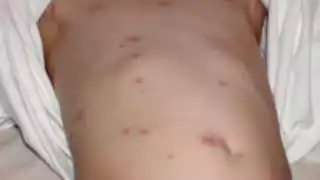 Casos sospechosos de sarampión suben a 28 en Quintana Roo; confirman uno en Bacalar   