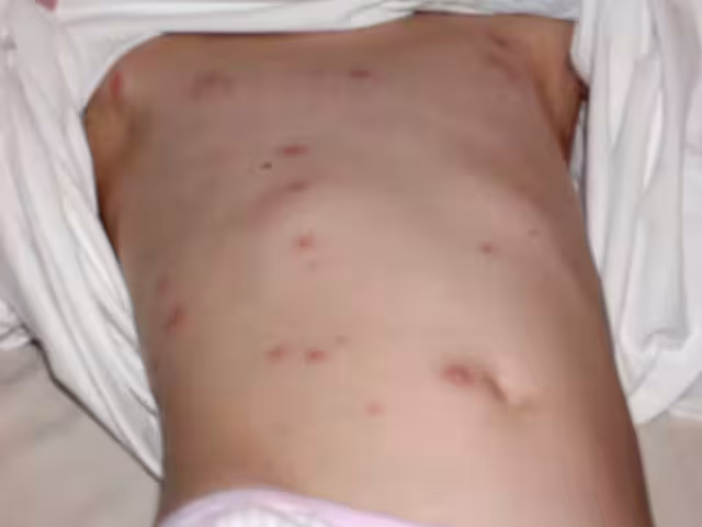 Quintana Roo registra incremento de casos sospechosos de sarampión; exhortan a vacunarse