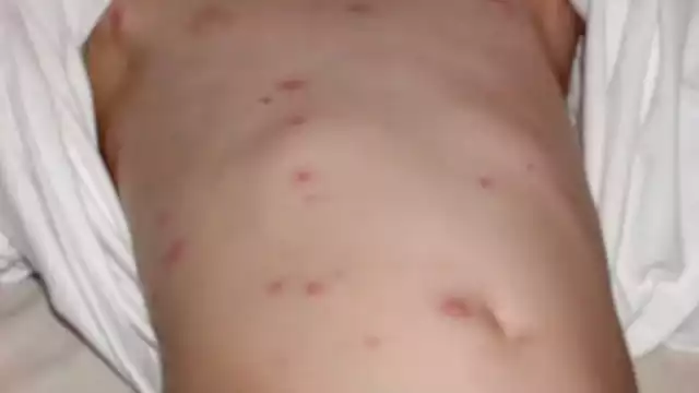 Quintana Roo registra incremento de casos sospechosos de sarampión; exhortan a vacunarse