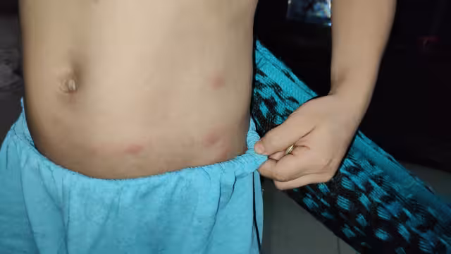 Separan a menores en Dzitbalché por sospecha de sarampión