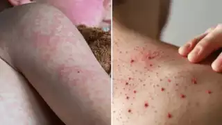 Alerta sanitaria en Campeche: Vigilan ocho posibles contagios de sarampión; ¿dónde se concentran? 