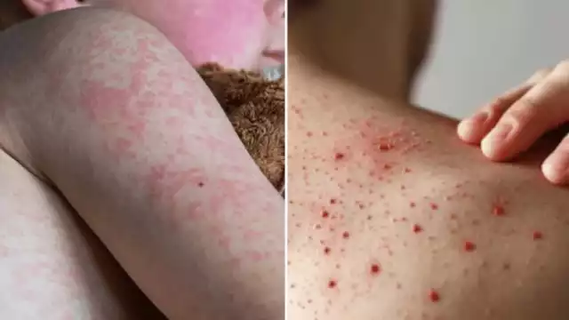 La SSA de Campeche mantiene bajo vigilancia a 8 personas que podrían haber contraído sarampión tras contacto con casos confirmados en Hopelchén