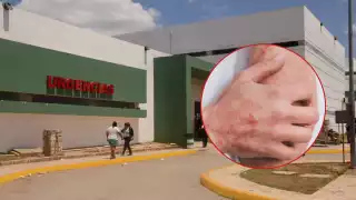 Más de 220 mil casos de escabiosis en 2025 posicionan a Q. Roo en el quinto lugar nacional