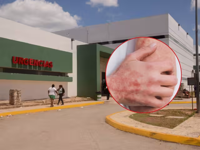 El ácaro Sarcoptes scabiei se introduce en la capa superior de la piel, donde deposita huevos, genera lesiones y picazón