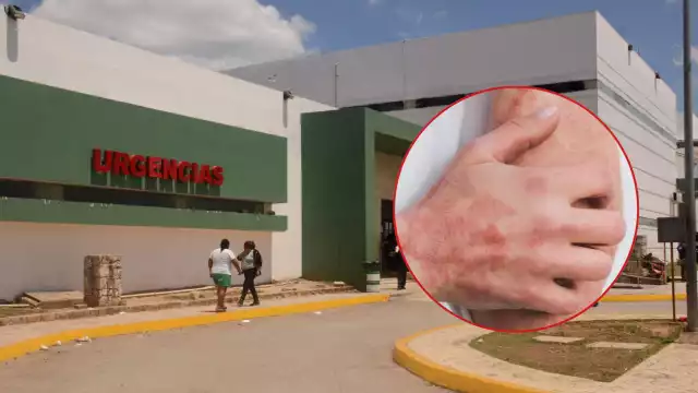 El ácaro Sarcoptes scabiei se introduce en la capa superior de la piel, donde deposita huevos, genera lesiones y picazón