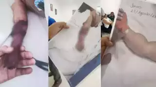 Bebé de cuatro meses víctima de presunta negligencia médica en  Cancún podría perder más extremidades