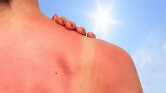 Las quemaduras solares y el daño acumulado por radiación pueden derivar en cáncer de pie