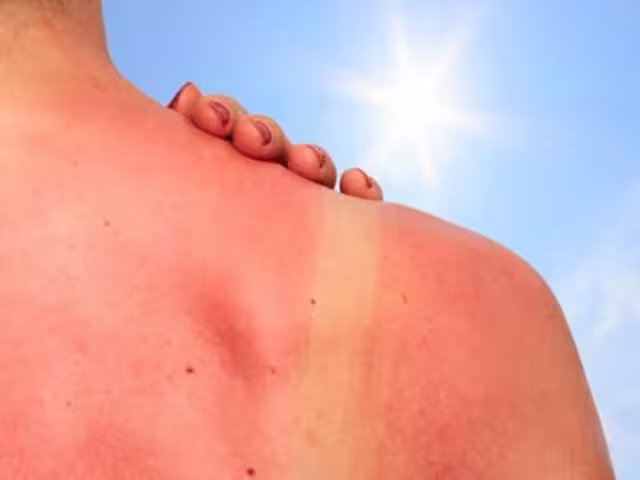 Las quemaduras solares y el daño acumulado por radiación pueden derivar en cáncer de pie