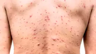 Registran nuevos casos de contagios por mpox en Quintana Roo