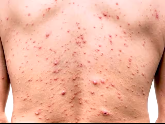 La alta incidencia de enfermos colocó a la entidad en el tercer lugar a nivel nacional, por encima de Ciudad de México y Baja California.