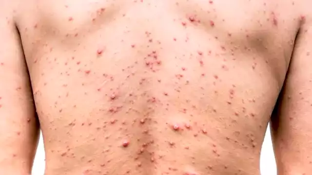 La alta incidencia de enfermos colocó a la entidad en el tercer lugar a nivel nacional, por encima de Ciudad de México y Baja California.