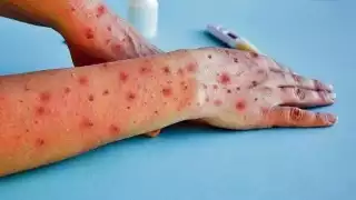 Salud Campeche minimiza riesgo de mpox; aún no crean cerco sanitario ante llegada de migrantes    