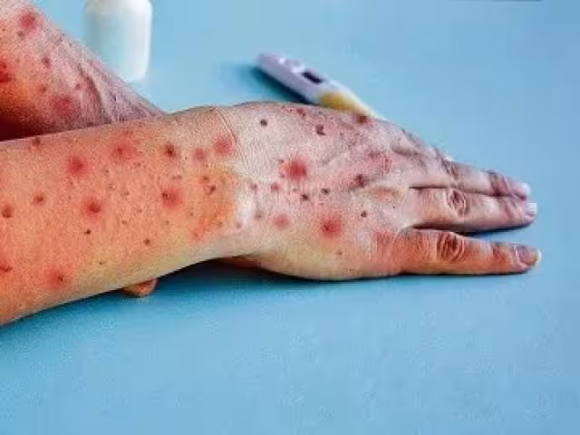 Exhortan a la población que en caso de presentar síntomas acudir a un Centro de Salud.