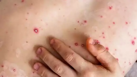 ONU buscará crear reserva de vacunas contra la viruela mpox ONU buscará crear reserva de vacunas contra la viruela mpox