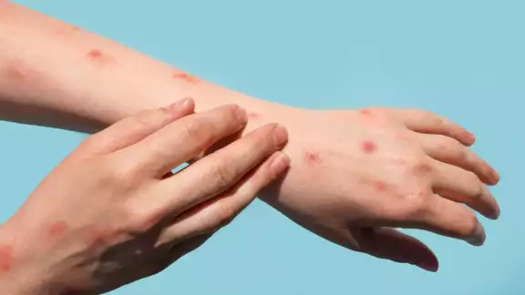 Semana de Salud inicia con preocupación por brote de sarampión Semana de Salud inicia con preocupación por brote de sarampión