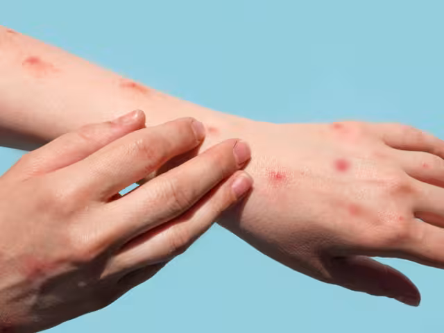 Semana de Salud inicia con preocupación por brote de sarampión