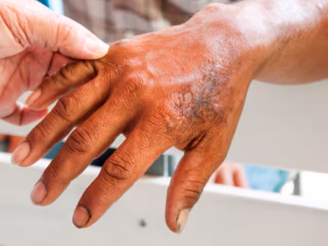 Campeche confirma su primer caso de lepra en 2025 durante la semana epidemiológica 15.