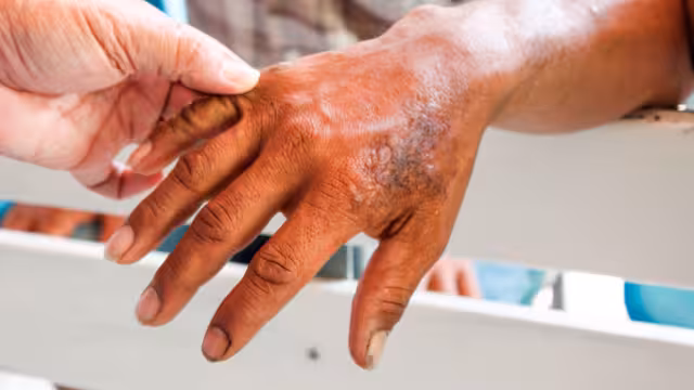 Campeche confirma su primer caso de lepra en 2025 durante la semana epidemiológica 15.