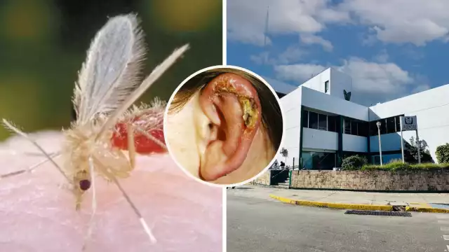 La Leishmaniasis tiene mayor incidencia en Candelaria, Calakmul y parte de Hopelchén por la vegetación; también es tratable, aunque las lesiones no cierran.