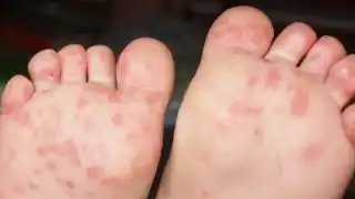 De acuerdo a la dependencia estatal de Salud, se aplicaron los protocolos en la estancia denunciada por presunto brote del virus para evitar su propagación.