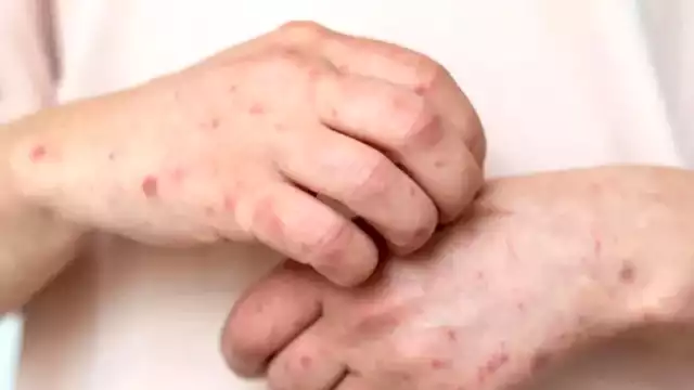 Los síntomas más frecuentes son fiebre, dolor de cabeza, cansancio y erupciones cutáneas en el cuerpo