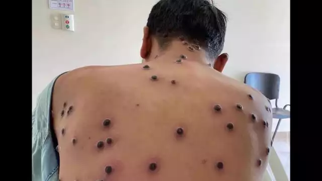 El director de la OMS, Tedros Adhanom, declaró emergencia sanitaria internacional por el brote de mpox, mejor conocida como viruela del mono