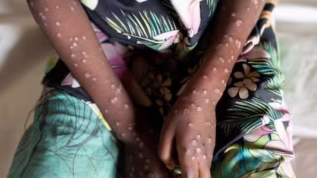 Quintana Roo registra 8 casos de mpox en 2024