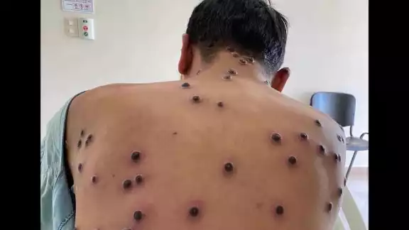 La Secretaría de Salud informó que en México se han registrado 212 casos de Mpox