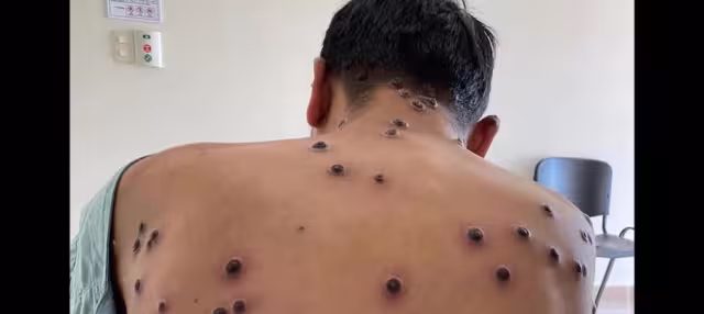 La Secretaría de Salud informó que en México se han registrado 212 casos de Mpox