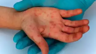 México busca erradicar el sarampión antes de noviembre: van más de 3,700 casos y 12 muertes